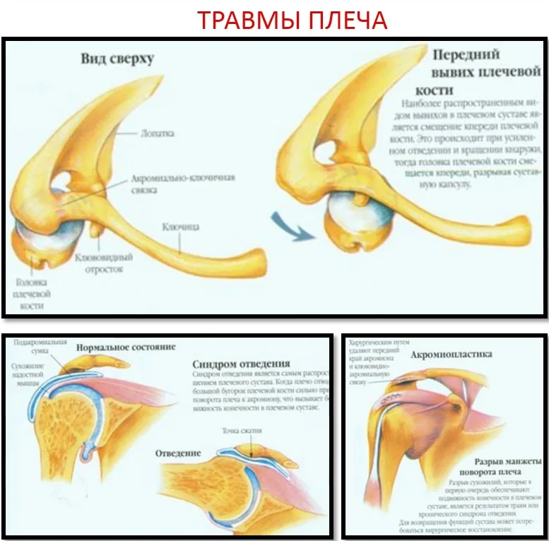 Стенд Зарница травмы плеча